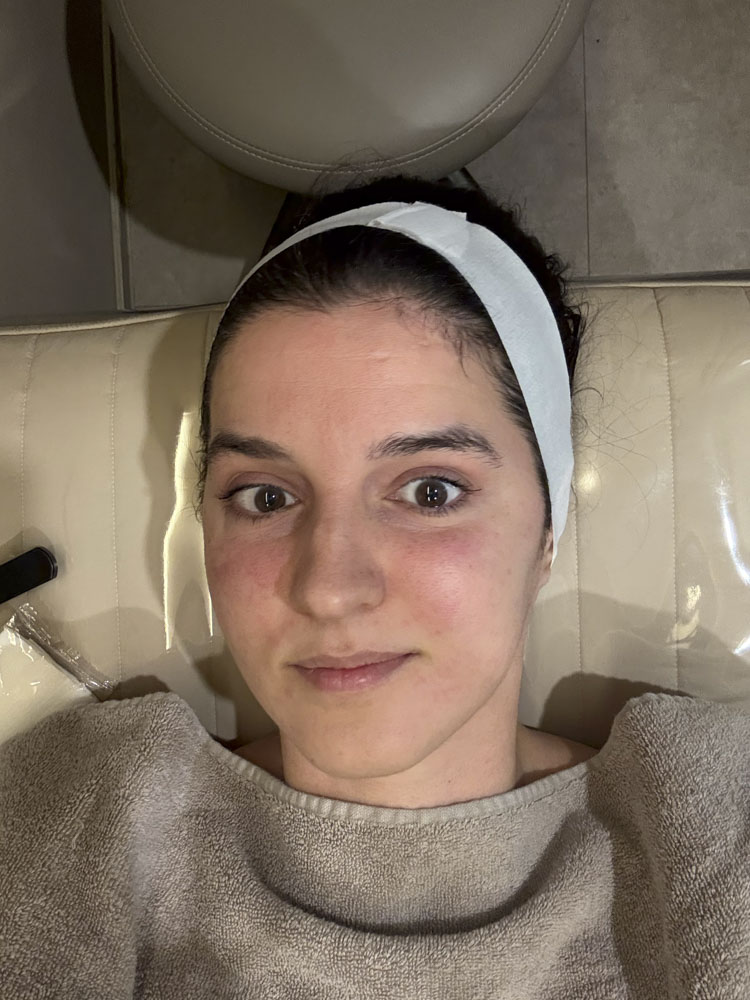 after treatment at Korean Skin Clinic: Pria